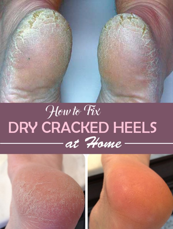 fix dry cracked heels