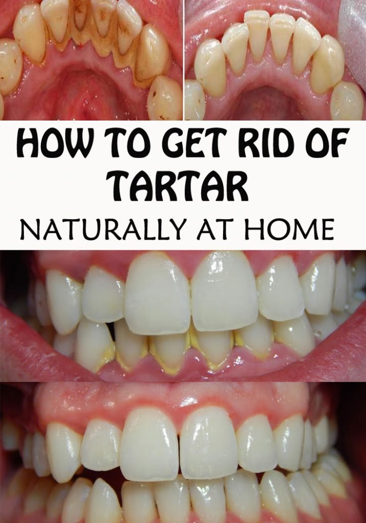 how-to-get-rid-of-tooth-tartar-naturally-at-home-everything-in-one-place