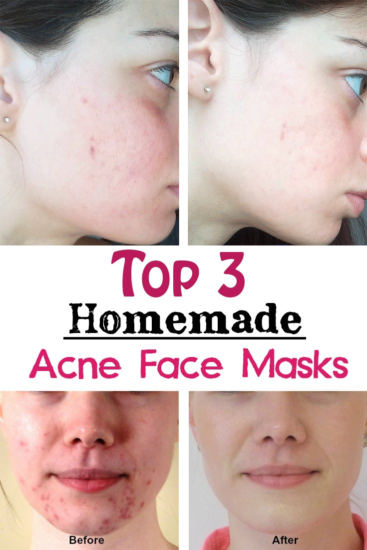 acne mask