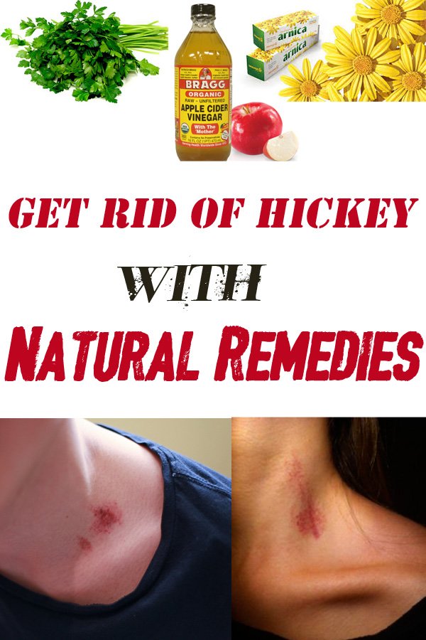 To rid most get effective a hickey of way Most Effective