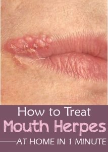 How to Treat Mouth Herpes at Home in 1 Minute - Everything in one place