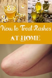 How to Treat Rashes at Home - Everything in one place